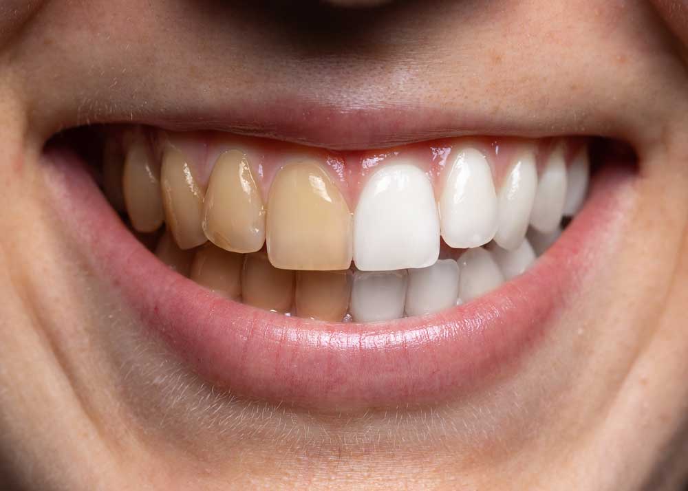 remove coffee stains on teeth before after